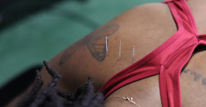 Dry Needling for Tension Headaches: Why the Real Trigger Point Is in Your Upper Traps, Not Your Head