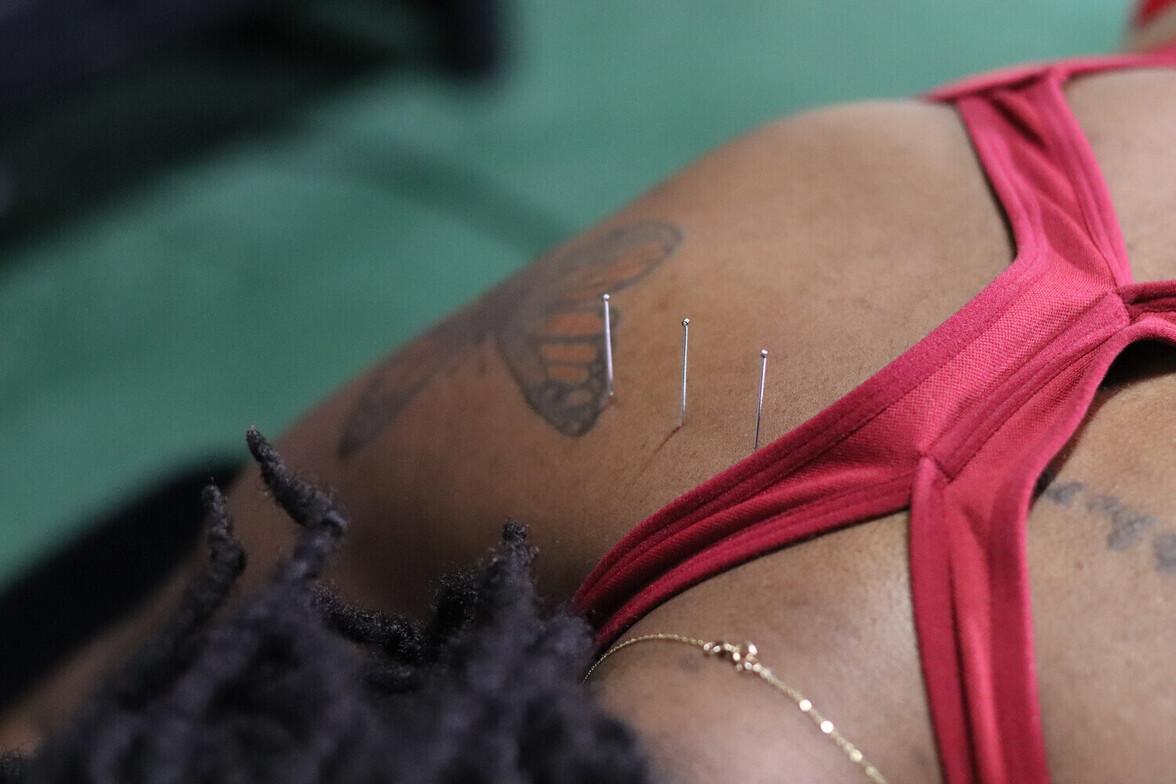 Dry needling treatment with thin filament needles inserted into the upper trapezius muscle to release trigger points that cause tension headaches