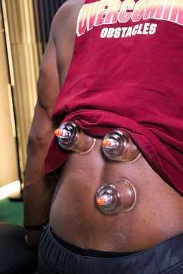 Cupping therapy with vacuum cups applied to an athlete's lower back to relieve tightness and improve mobility at Limitless Sports Chiropractic.