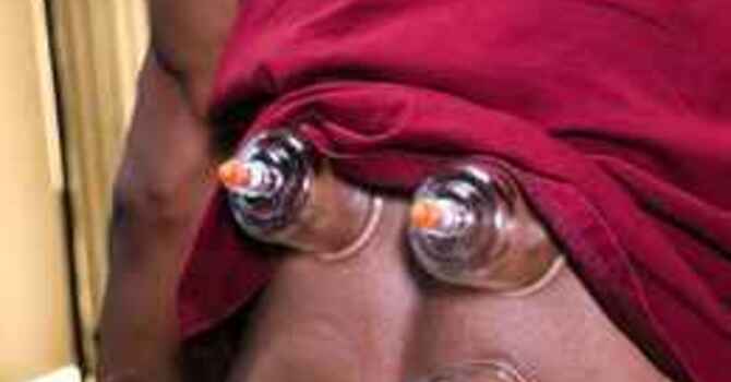 Cupping Therapy for Low Back Tightness: Why Adding Motion Speeds Up Recovery Between Adjustments