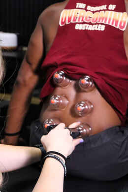 Cupping therapy with active motion applied to an athlete's upper back and shoulder blade area to relieve chronic shoulder and upper back tightness at Limitless Sports Chiropractic.