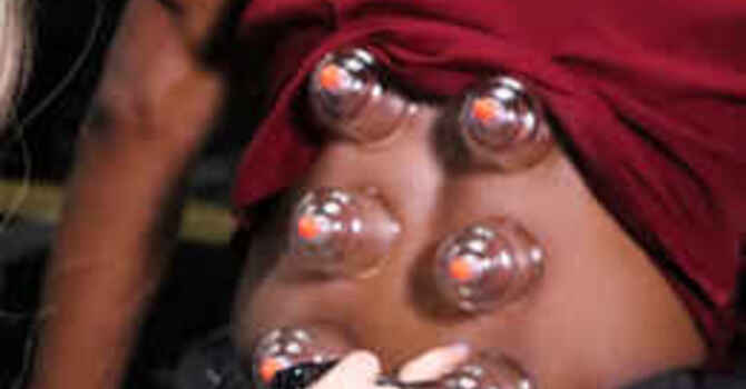Cupping Therapy for Shoulder and Upper Back Tightness: Why This Quick Add-On Works Between Adjustments