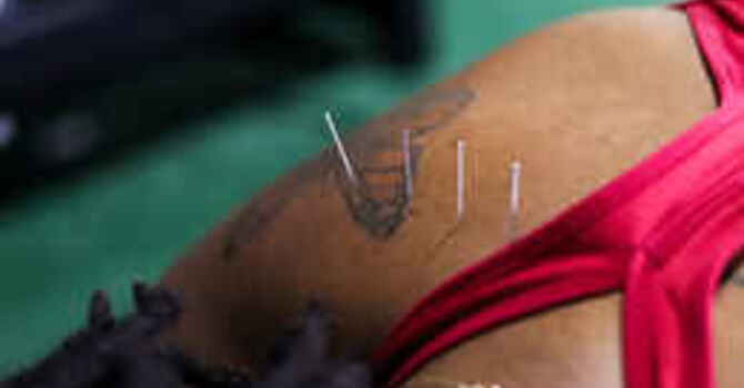 Dry Needling for TMJ Dysfunction: Why Jaw Pain, Clenching, and Headaches Often Start in the Muscles