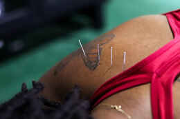 Dry needling filament needles inserted into a patient's arm muscle, the same trigger-point release technique used to treat TMJ dysfunction and jaw muscle tension at Limitless Sports Chiropractic.