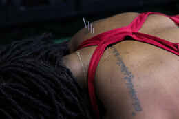 Dry needling filament needles inserted into a patient's arm muscle, the trigger-point release technique used to treat the muscle tension contributing to elbow bursitis at Limitless Sports Chiropractic.