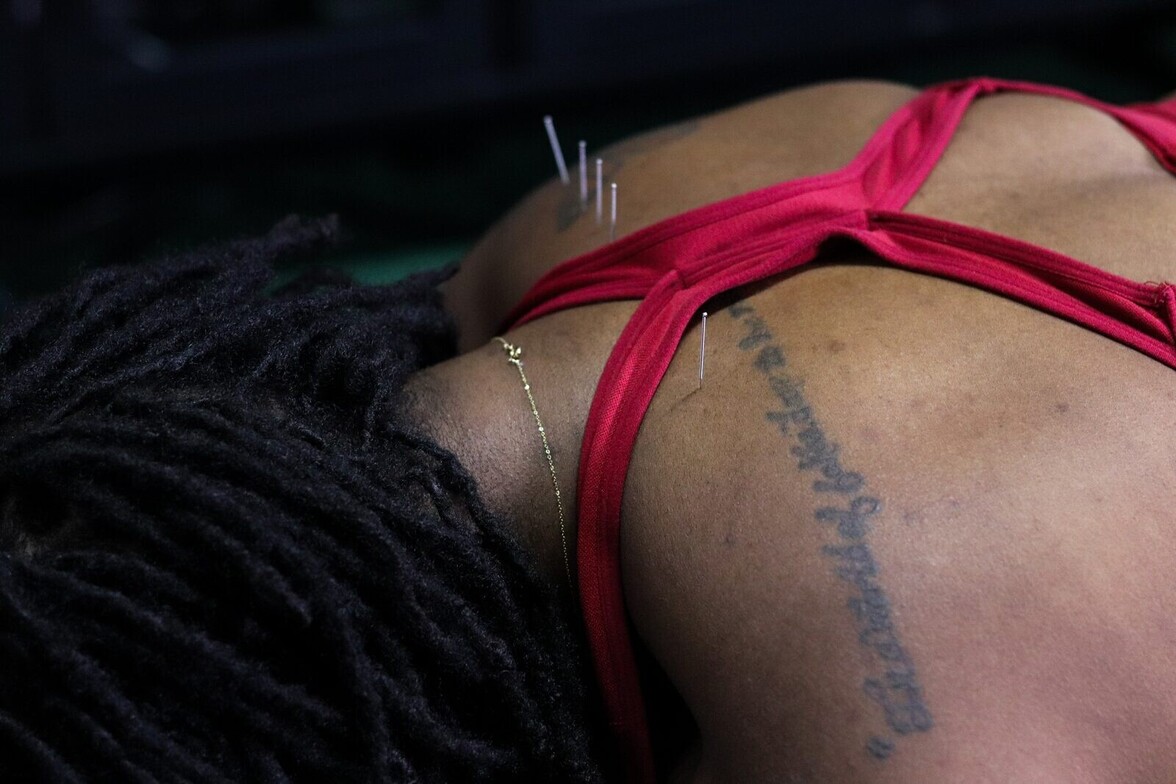 Dry needling filament needles inserted into a patient's arm muscle, the trigger-point release technique used to treat the muscle tension contributing to elbow bursitis at Limitless Sports Chiropractic.