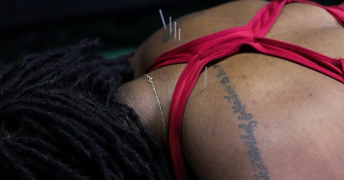 Dry Needling for Elbow Bursitis: Why That Swollen, Achy Elbow Isn't Tennis Elbow