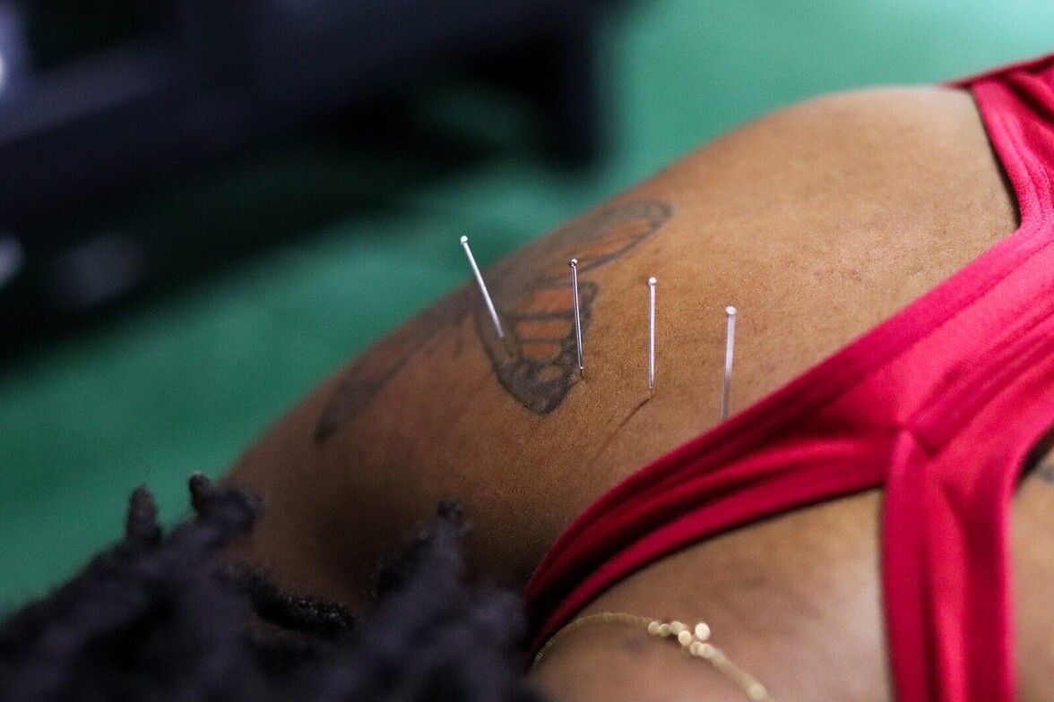 Dry needling filament needles inserted into a patient's arm muscle, the same trigger-point release technique used to treat TMJ dysfunction and jaw muscle tension at Limitless Sports Chiropractic.