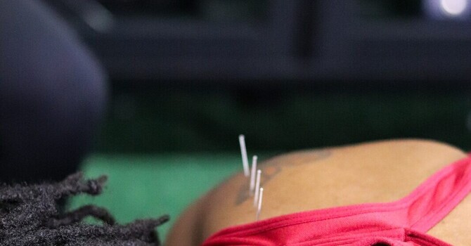Dry Needling for Knee Pain: Why the Real Problem Is Often in the Muscles Around the Joint